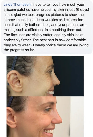 Silicone Scar Sheets